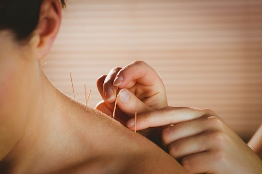 Acupuncture needles.